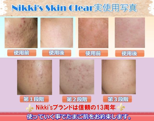 しみ、そばかす、ニキビ跡、毛穴　噂のNikki's Skin Clear　通常版